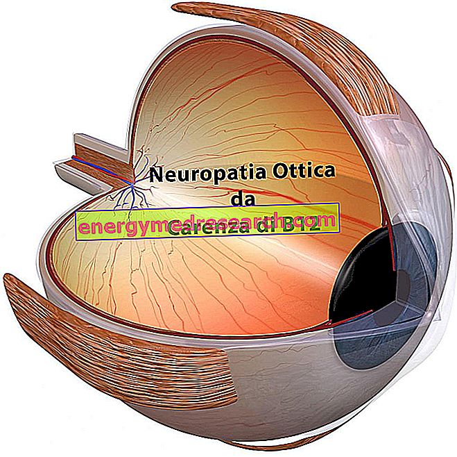 Дефицит В12 и оптическая нейропатия