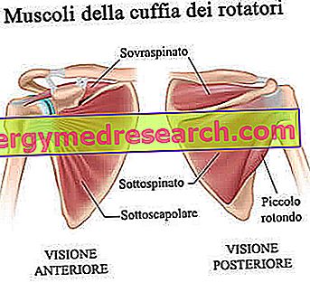 Deteriorarea tendonului mușchiului supraspinat al articulației umărului