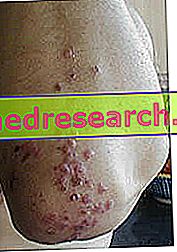Dermatitis herpetiforme: dermatitis de Duhring