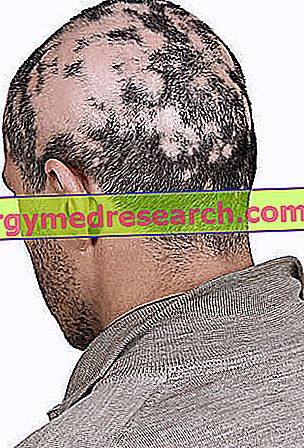 Plaukų slinkimas (Alopecija) – ingridasimonyte.lt
