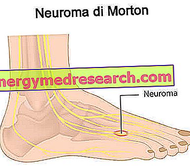 Geneesmiddelen voor de behandeling van Morton's neuroma