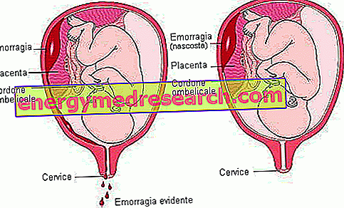 Плацента детацхмент