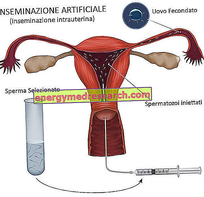 Artificial insemination