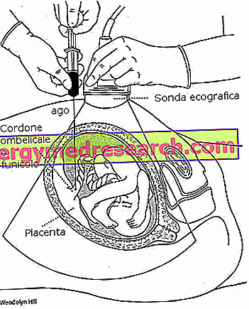 Cordocentesis - Funiculocentesi