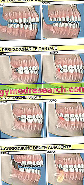 Judgment tooth extraction