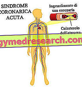 Syndrome coronaire aigu