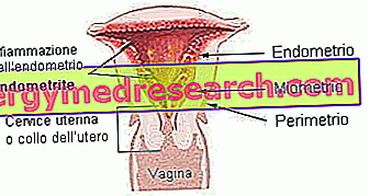 endometrite