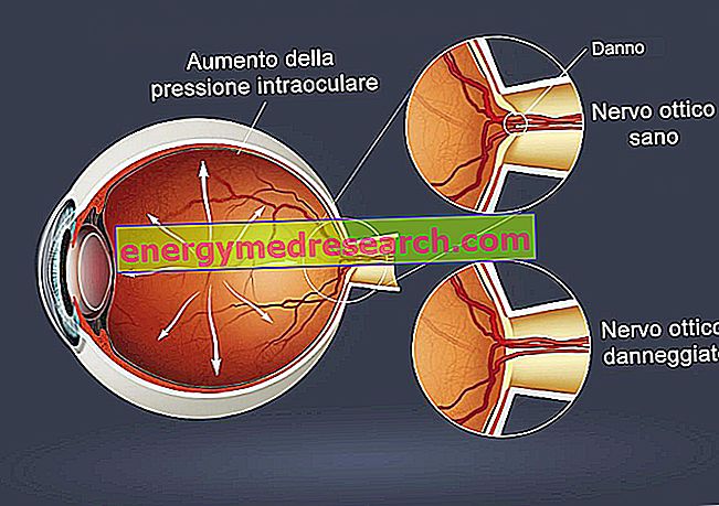 ग्लूकोमा: आंखों की रोशनी के परिणाम क्या हैं?