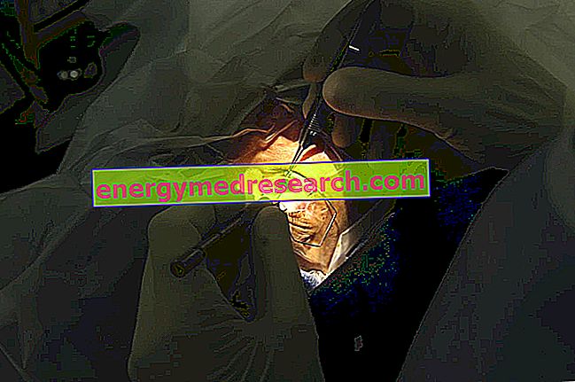 A femtoszekundum lézerfordulat a szürkehályog kezelésére