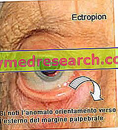 Ektropium (Außenrotation des Augenlids)