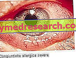 Алергічний кон'юнктивіт: причини і симптоми