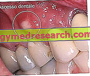 Absceso dental: causas y síntomas