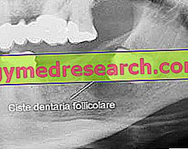 Dental cysts
