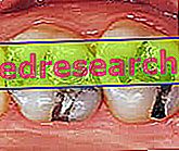 Obturación del diente