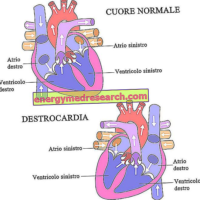 Dextrocardia, khi trái tim ở bên phải chứ không phải bên trái