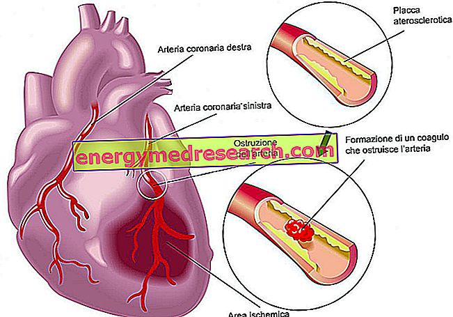 Kaip širdies priepuolis gali išgelbėti jūsų gyvybę - Kapitalo Kardiologija Associates 