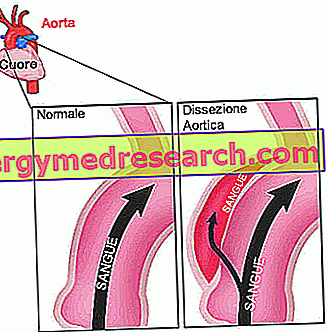 Disekcija aorte