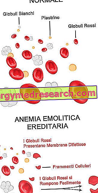 Hemolitička anemija