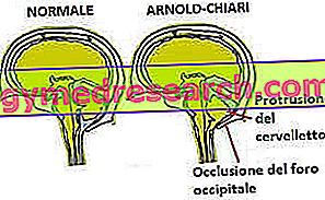 Arnold-Chiari sindrom