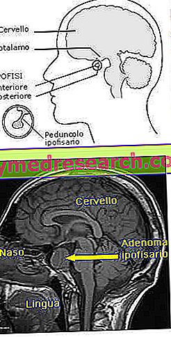 svorio hipofizės adenoma)