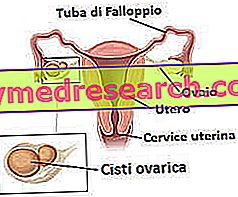 Chist ovarian - chisturi ovariene