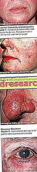 Akne rosacea: Määritelmä, oireet ja riskitekijät