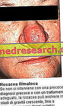 Acné rosacée: diagnostic, traitement et prévention