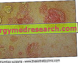Boală articulară care afectează pielea membranei mucoase. Lupusul Eritematos Sistemic