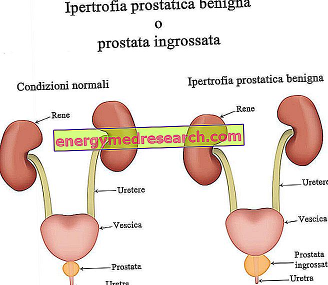 Aké sú výsledky TURP u pacientov s benígnou hypertrofiou prostaty?