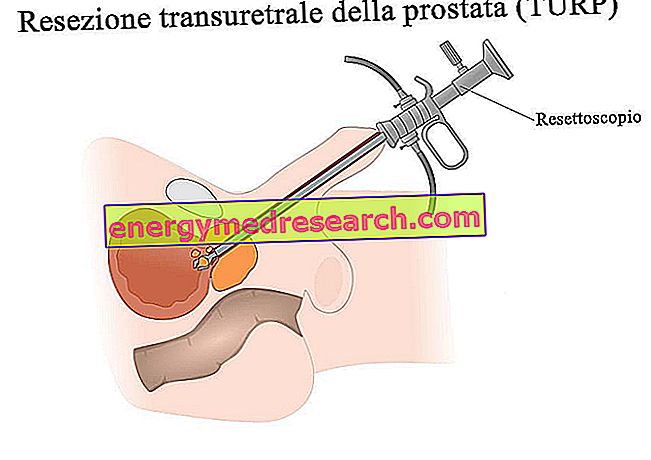 Hlavní operační kroky transuretrální resekce prostaty