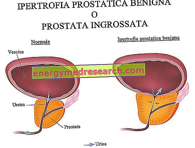 Co je to transuretrální resekce prostaty a kdy je zavedena do praxe?