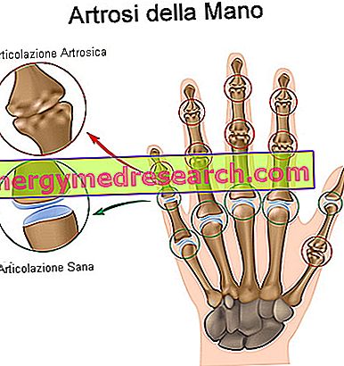 artroza nodulară a articulațiilor mâinilor)