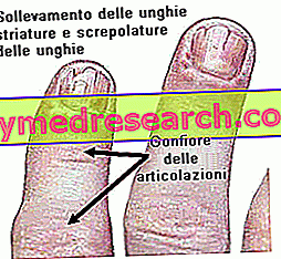 Psoriatická artritida