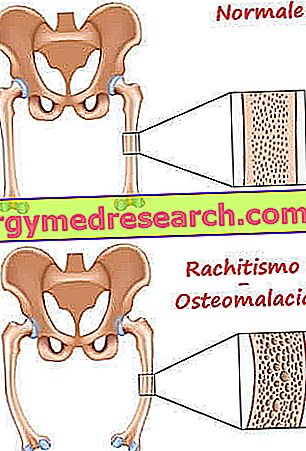 osteomalácia