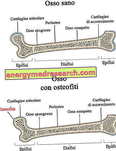 osteophytosis