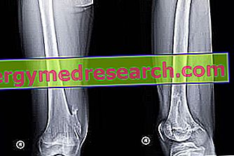 Ce cauzează artrită calcaneală și cum să o tratezi. - Dermatită November