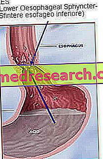 Gastroösophagealis reflux betegség - GERD: meghatározás, okok, tünetek