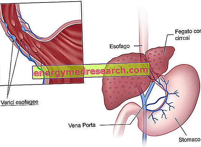 Esophageal varices