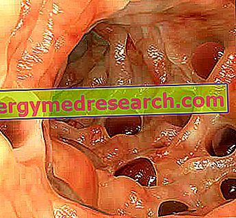 Remedies for diverticulitis