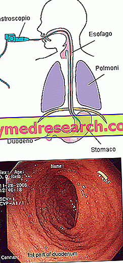 stemplės hipertenzija)