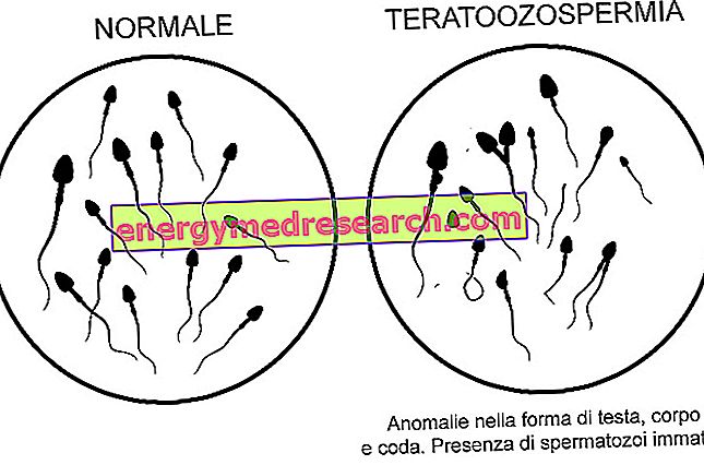 teratozoospermia