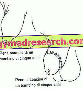 circoncision