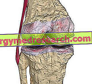 Artroza koljena kod A.Griguola