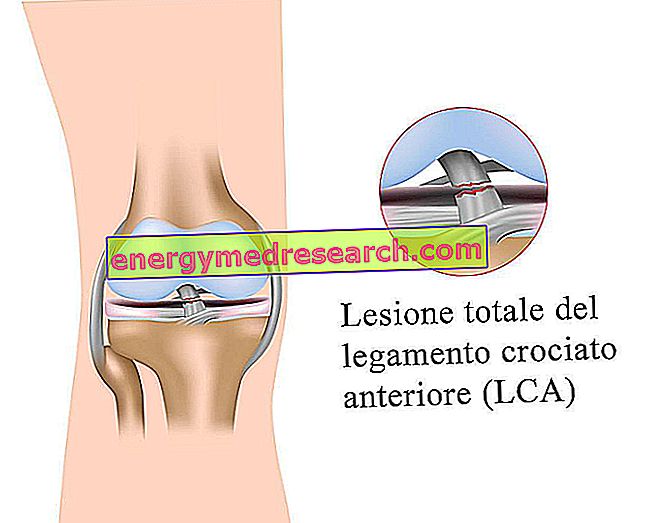 Rekonštrukcia predného prekríženého väzu kolena: prečo zasahujeme?