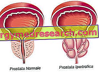 hipertenzija ir prostatos vėžys)