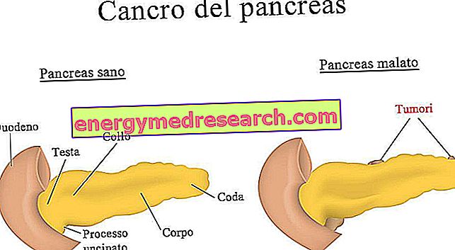 Seberapa luaskah kanker pankreas?