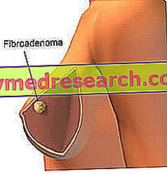 Fibroadenoma z dojko
