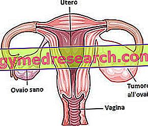 Cancer ovarian - Cancer ovarian - Cancer ovarian