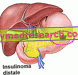 inzulinómát